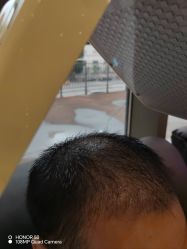 -碧莲盛·不剃发植发