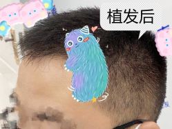 -大麦微针植发全国连锁