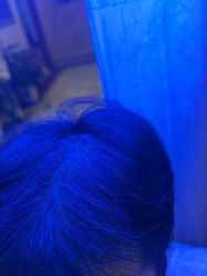 -碧莲盛·不剃发植发