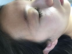 -美丽人生祛斑扁平疣汗管瘤中心