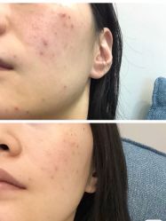 -苗方清颜痘肌研究所