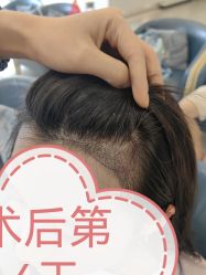 -大麦微针植发全国连锁