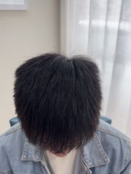 -大麦微针植发丨全国连锁