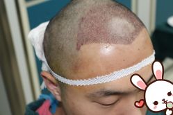 点击看大图 -大麦微针植发丨全国连锁