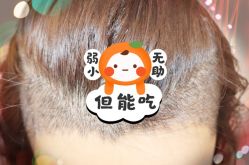 -大麦微针植发全国连锁