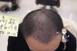 -大麦微针植发丨全国连锁