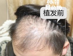 -大麦微针植发全国连锁