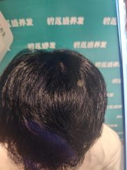 -碧莲盛·不剃发植发