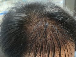 -碧莲盛·不剃发植发