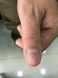 点击看大图 -德哥灰指甲脚气甲沟炎跖疣护理