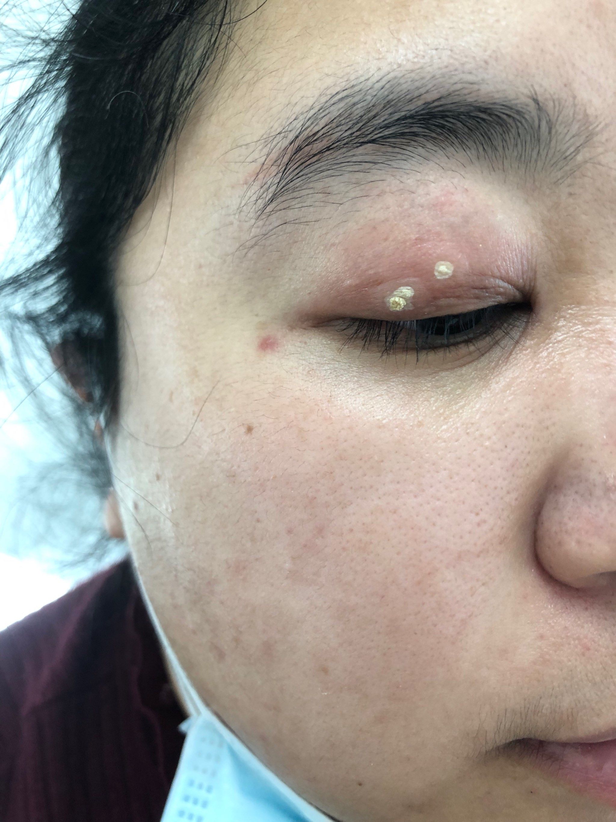 眼皮上以为是脂肪粒也没管它后来一个遍成两