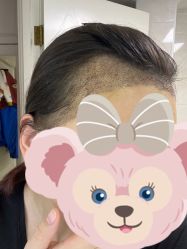 体验后-熙朵美学植发·连锁品牌