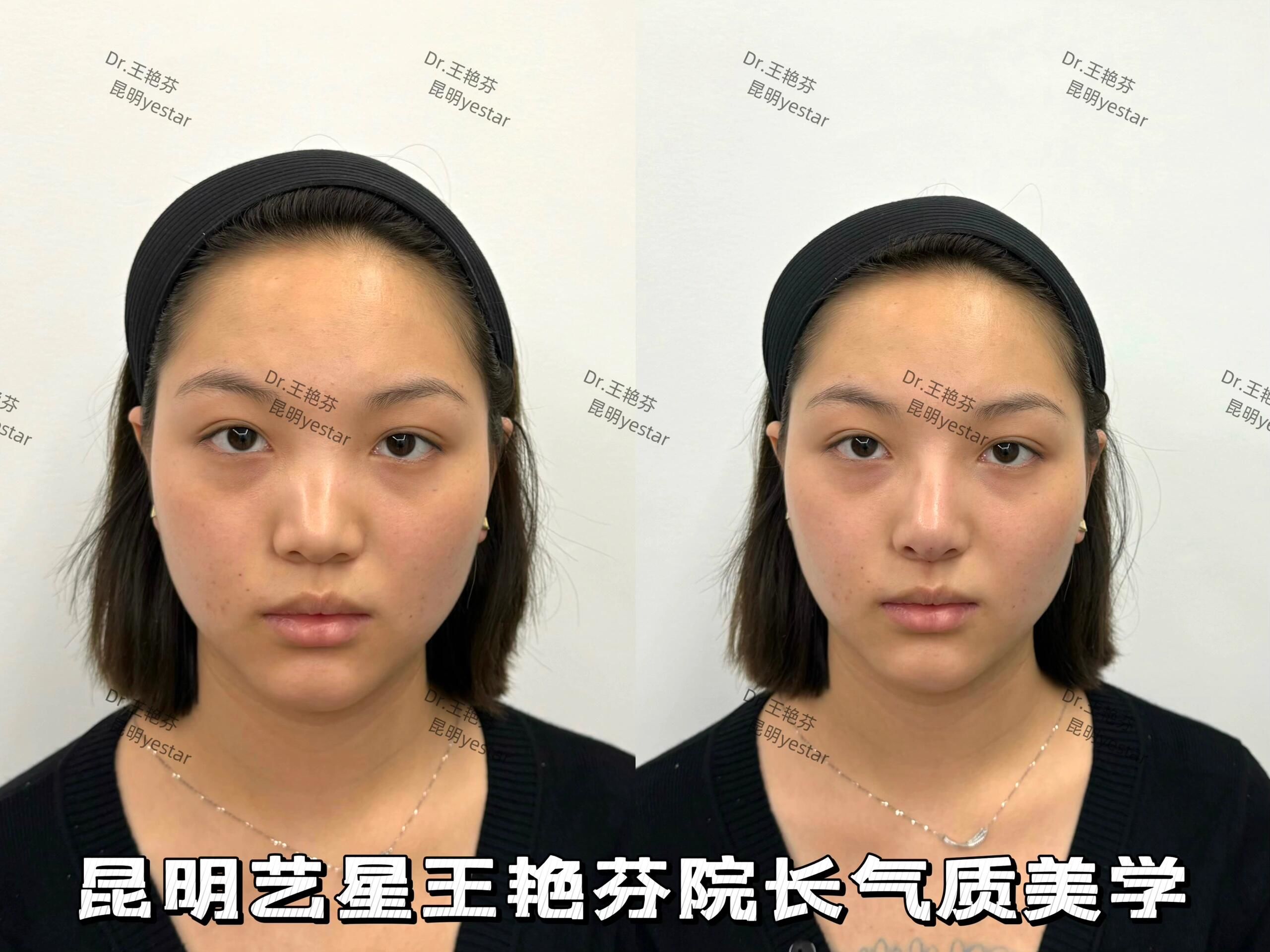 74宽鼻背的宝子们看过来98
夏天之前想do鼻,又不想动刀92
