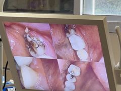 -上海仁爱医院口腔科 · 种植
