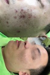 -苗医生草本科技祛痘