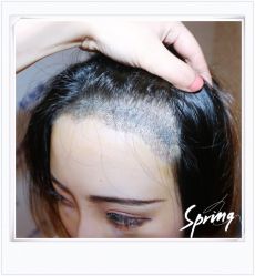 点击看大图 体验后-大麦微针植发全国连锁