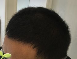 -大麦微针植发丨全国连锁