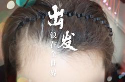 -大麦微针植发全国连锁