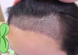 -大麦微针植发丨全国连锁