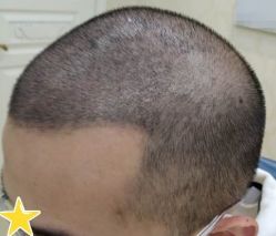 -大麦微针植发丨全国连锁