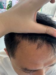 -大麦微针植发全国连锁