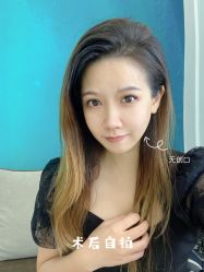 体验后-广州健丽·去眼袋医疗美容机构