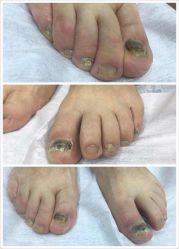 点击看大图 -德哥灰指甲脚气甲沟炎跖疣护理
