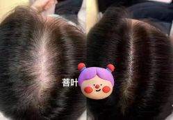 -菩叶脱发白发中心
