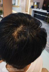 -碧莲盛·不剃发植发