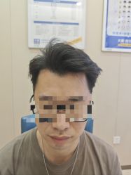 -大麦微针植发全国连锁