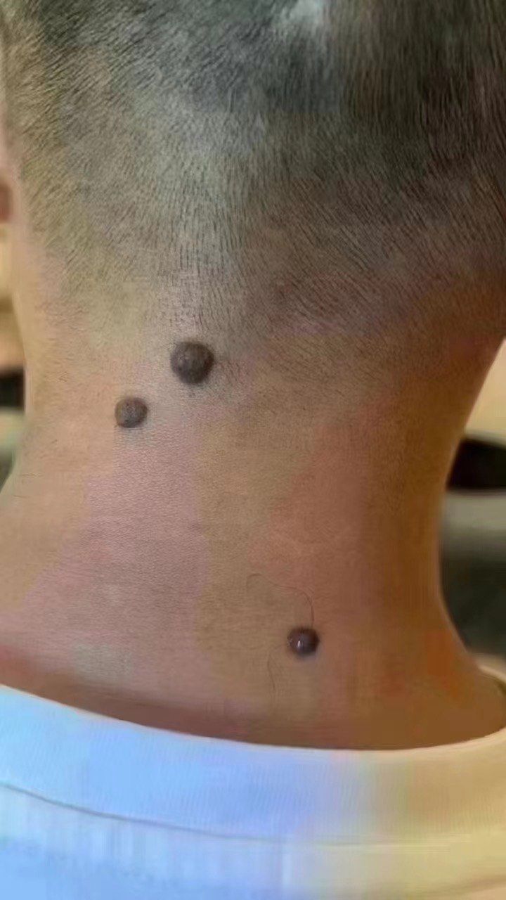 这种痣还要养着吗?