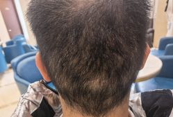 -碧莲盛·不剃发植发