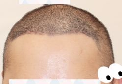 -大麦微针植发全国连锁