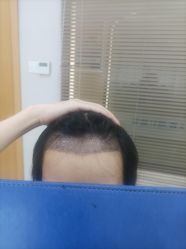 -大麦微针植发丨全国连锁