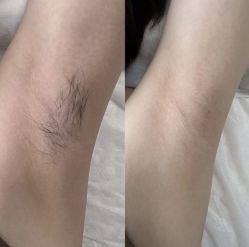 -薇兰专业脱毛连锁机构