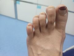 -Andrew指甲专科灰指甲·甲沟炎矫正·3D步态矫形鞋垫定制(上海法华镇路旗舰店)