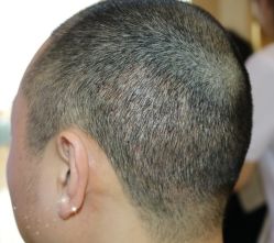 -大麦微针植发丨全国连锁