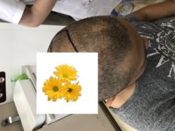 -大麦微针植发丨全国连锁