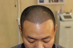 -大麦微针植发丨全国连锁