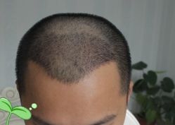 -大麦微针植发丨全国连锁