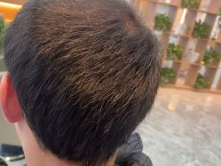 -碧莲盛·不剃发植发