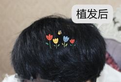 -大麦微针植发全国连锁