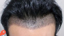 -大麦微针植发丨全国连锁