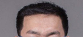 -大麦微针植发丨全国连锁