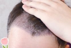 -大麦微针植发丨全国连锁