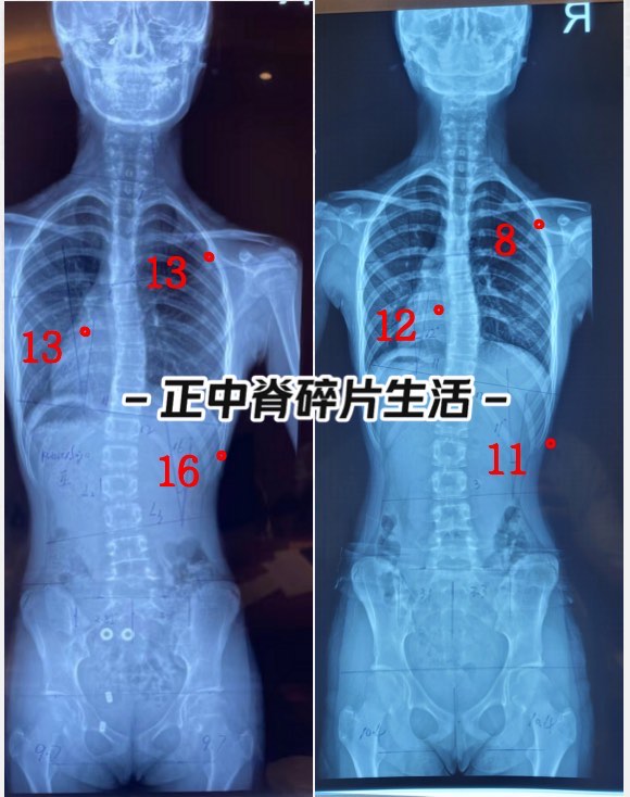 后背高低不平图片图片