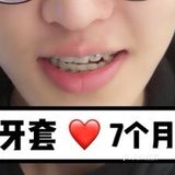 【案例分享】今天我们来讲个小帅哥的正畸案例