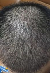 -大麦微针植发丨全国连锁