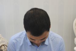 -大麦微针植发丨全国连锁