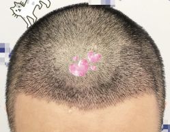 -大麦微针植发全国连锁